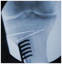 India Surgery High Tibial Osteotomy, Cost High Tibial Osteotomy Knee